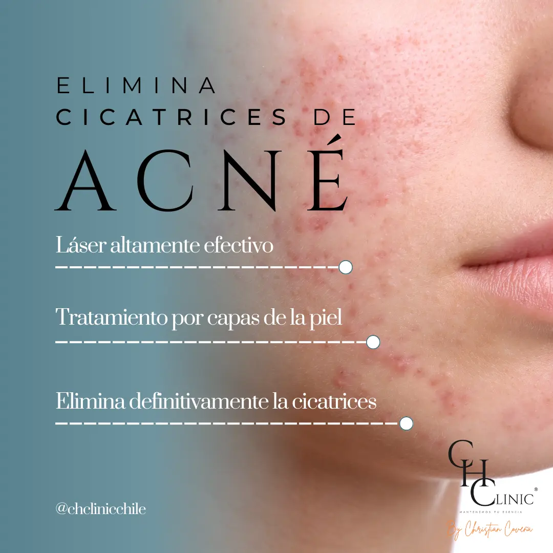 cicatrices de acne
