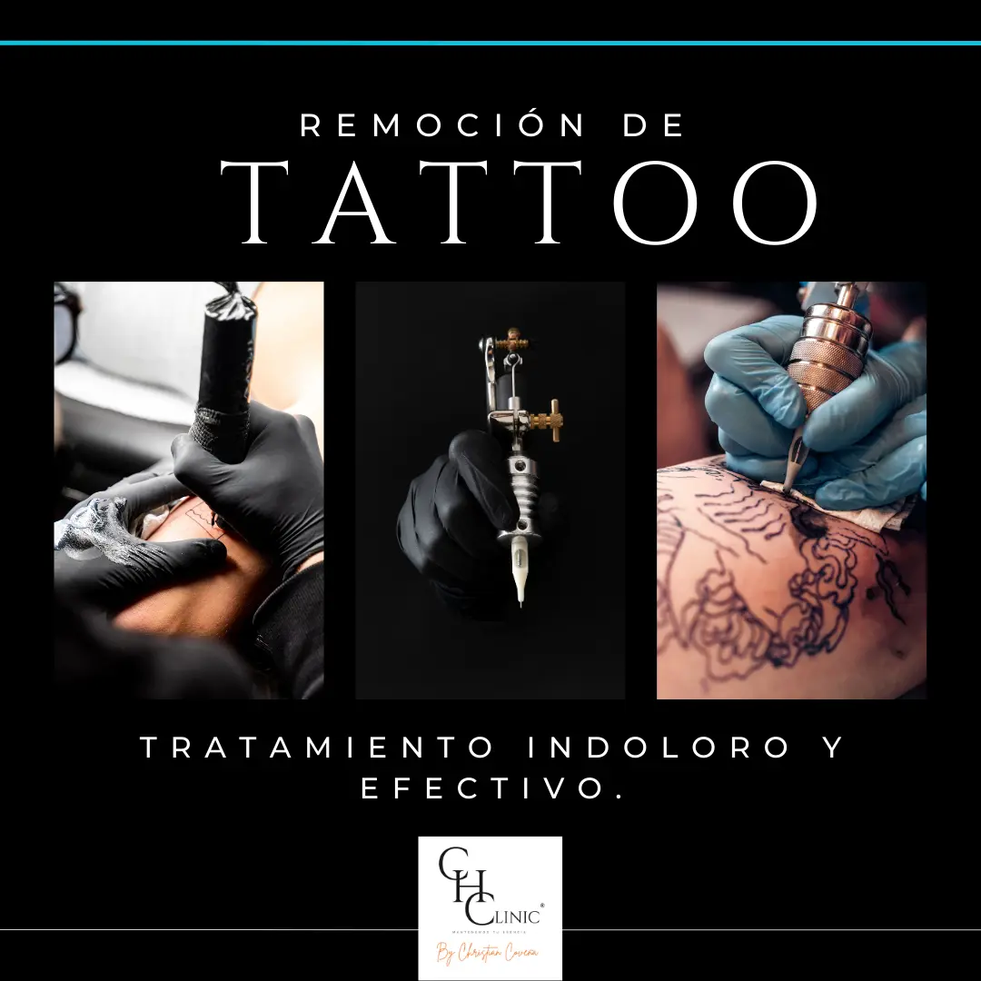 Remoción de Tatuajes